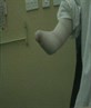 this my right deformed arm :(