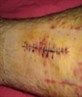 iraq op telic7 high velocity projectile wound
