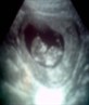 my baby girl at 11 week scan