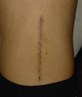 My scar after my spine operation...