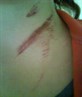 Car crash scar