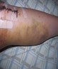 Aftermath of ACL/Outer later ligiment reconst