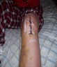 Aftermath of ACL/Outer later ligiment reconst