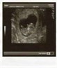 11 week scan!
