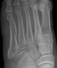 Spiral Fracture - 5th Metatarsal
