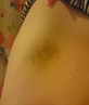 this bruise was on my hip... ouch!