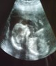 its a girl my scan at 21weeks