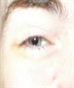 my eye + bruise
